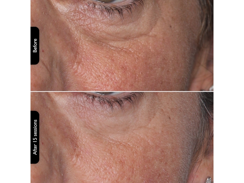 Silk'n Facial LED Mask Ansiktspleie