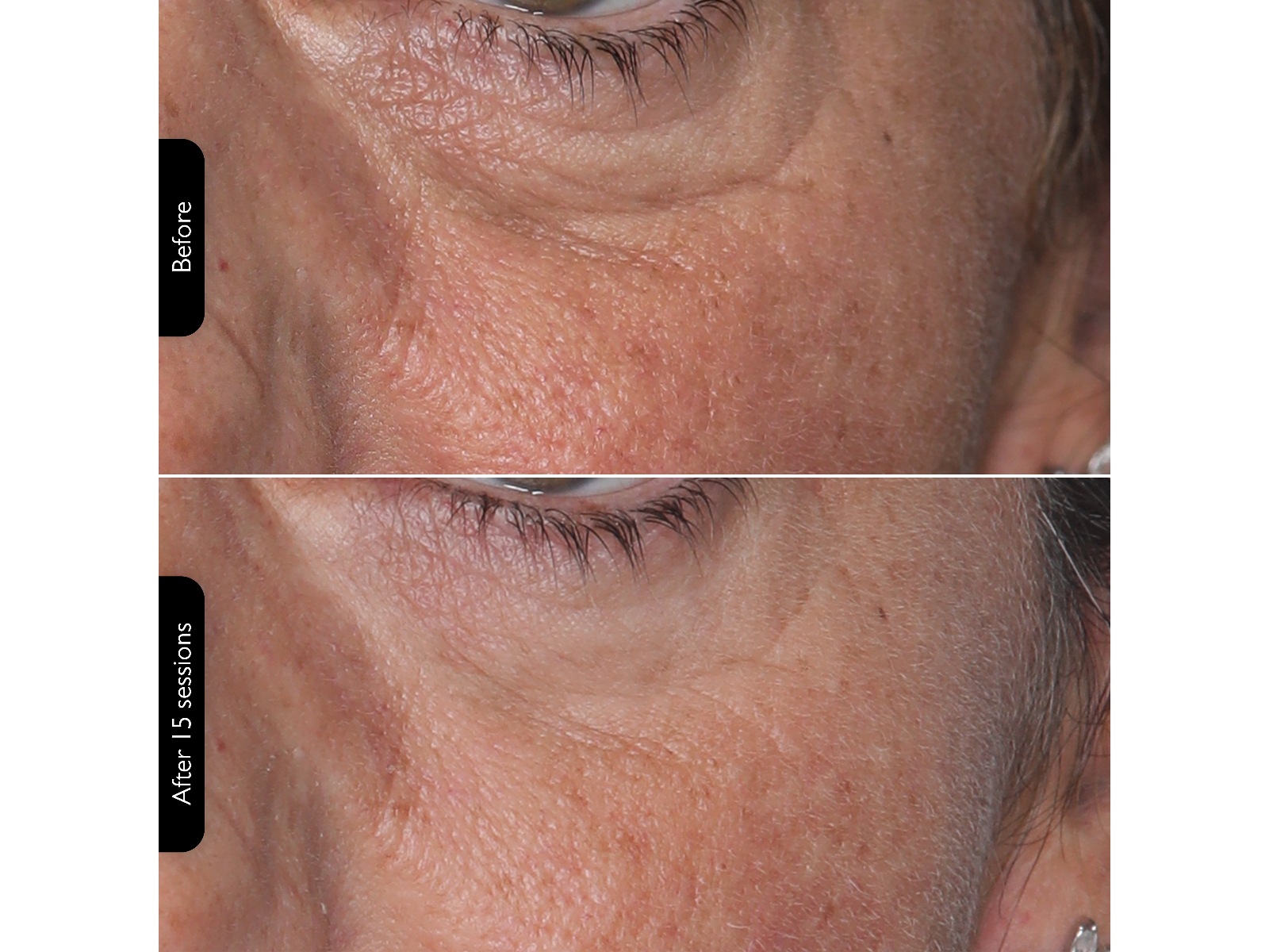 Silk'n Facial LED Mask Ansiktspleie