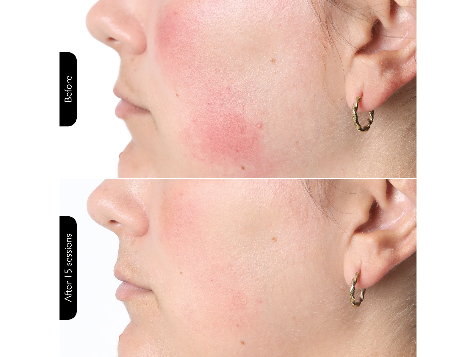 Silk'n Facial LED Mask Ansiktspleie