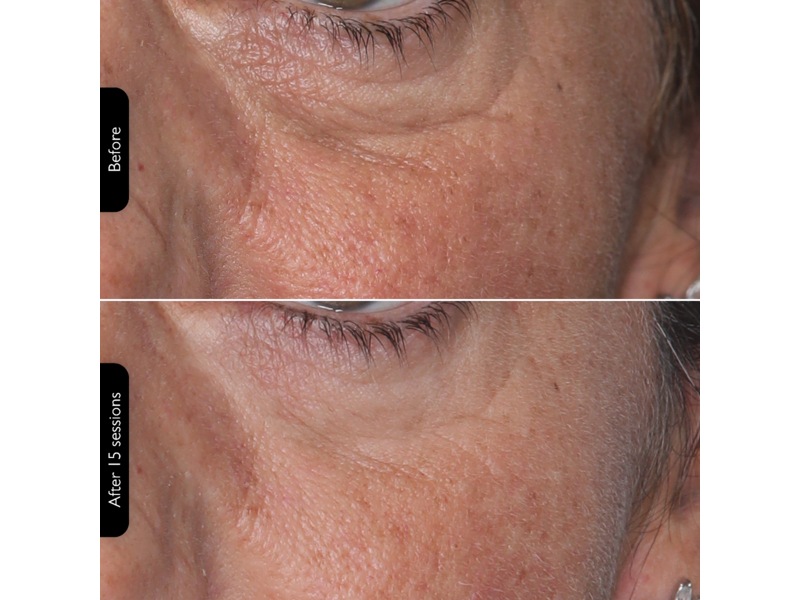 Silk'n Facial LED Mask Ansiktspleie